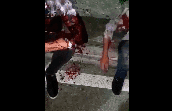 Joven pierde el brazo por accidente en Cancún y ni se inmuta