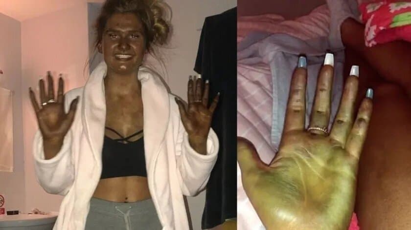 Se queda dormida mientras se bronceaba, termina verde y la llaman 'Fiona'