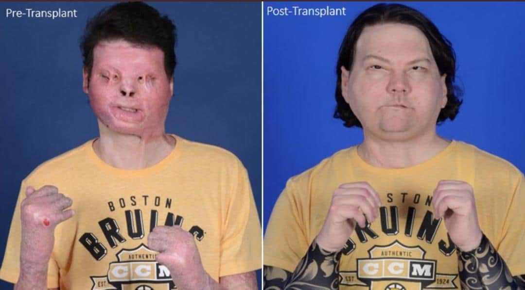 Exitoso, el primer trasplante de rostro y manos en el mundo