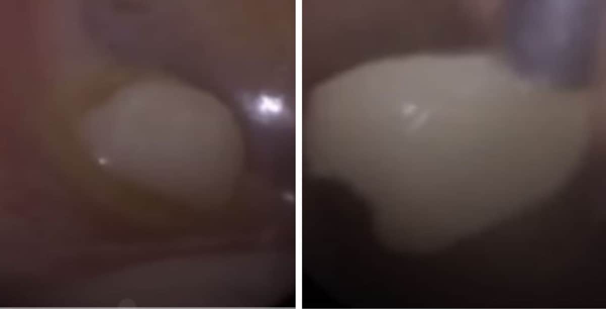 Video: Le sacan diente a niño atorado en el tímpano y se hace viral