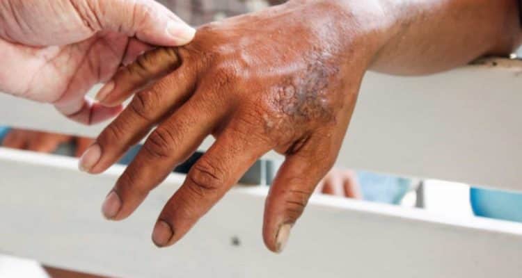 Registra Quintana Roo el primer caso de lepra en México de 2021