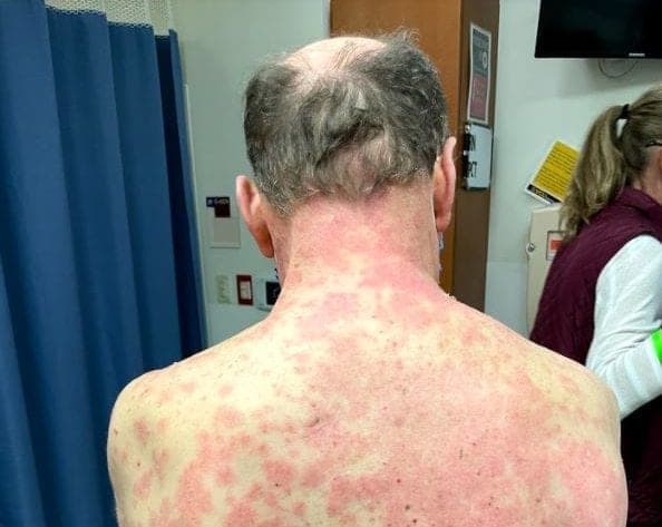 Abuelito de 70 años sufre de reacción en la piel luego de colocarse vacuna contra el Covid-19