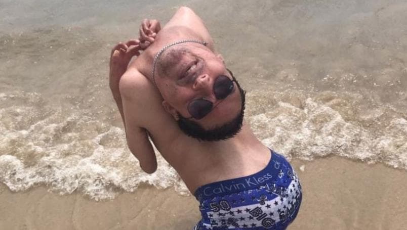 Hombre que nació con cabeza al revés, positivo a Covid-19 en Brasil