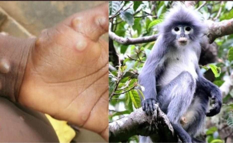 Detectan caso de viruela de mono en Texas; usar cubrebocas evita contagio