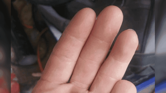 Se corta su dedo meñique y lo encuentra seis meses después