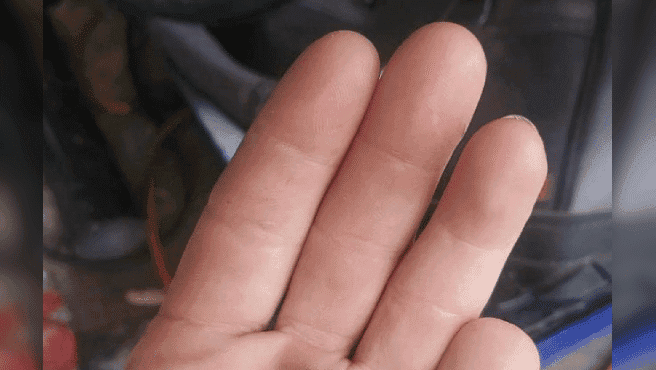 Se corta su dedo meñique y lo encuentra seis meses después