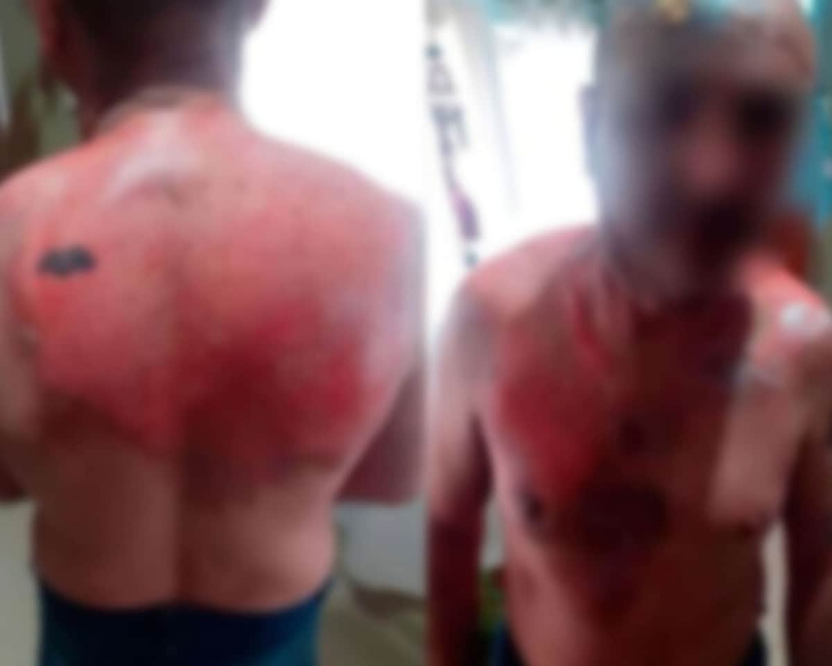 Le echa agua hirviendo a su exesposo por dejarla provocándole serias quemaduras