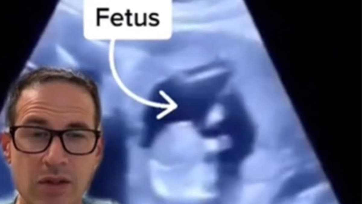 VIDEO DE EMBARAZO EXTREMO: Bebé crece en el hígado de su mamá