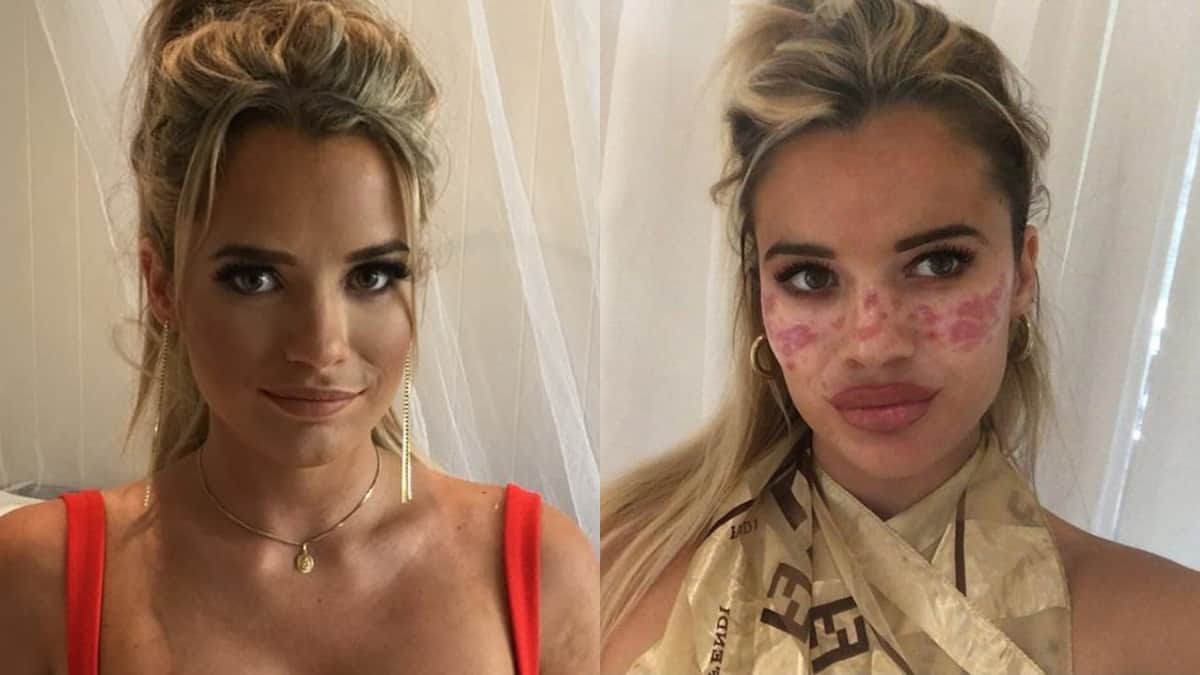 Modelo se queda ciega y se quema la cara por truco de belleza en TikTok