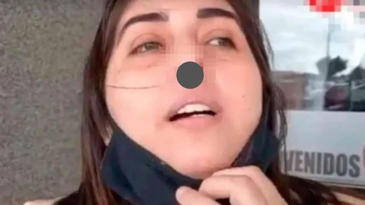 Mujer pierde el cartílago de la nariz tras mal hisopado para prueba de Covid-19