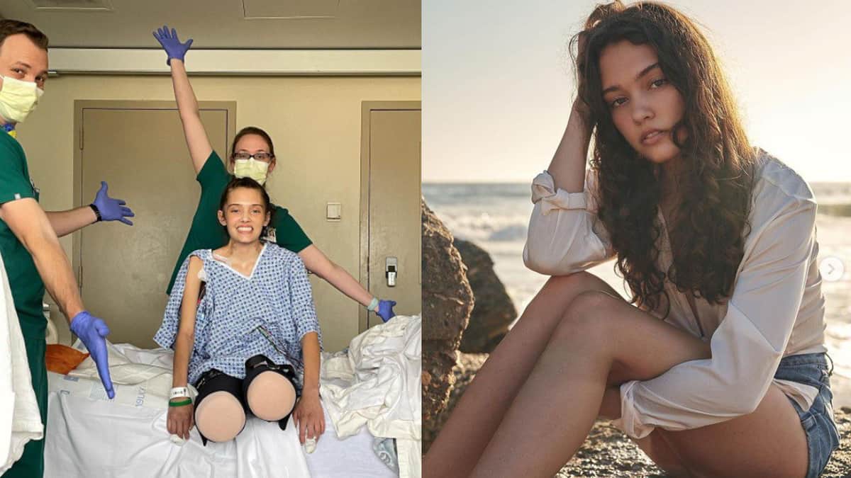 Por COVID-19, modelo sufre amputación de ambas piernas