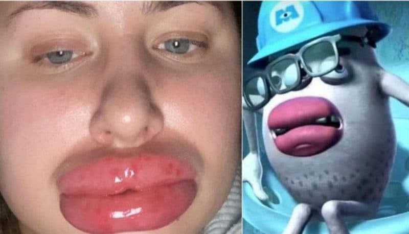 Joven termina pareciendo a un personaje de 'Monsters Inc' tras reacción alérgica