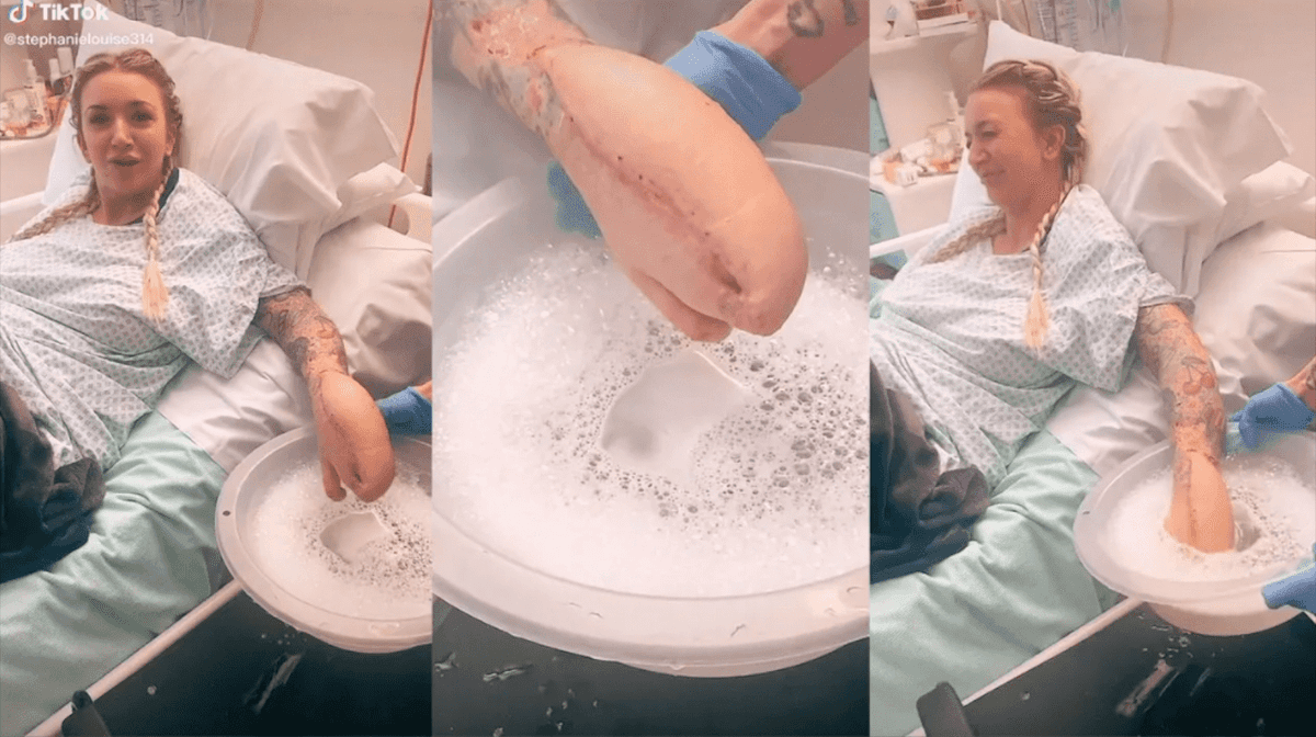 Mujer termina con “mano de tiburón” tras someterse a una operación