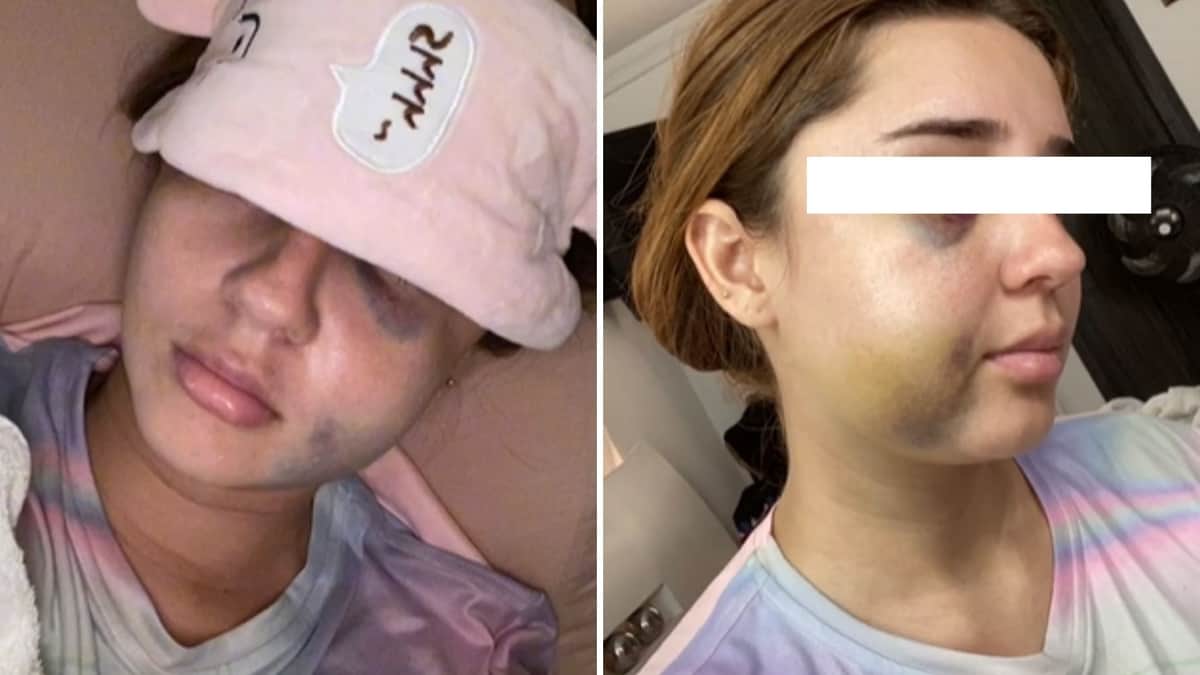 VIDEO: Joven estuvo a punto de perder la vida por cirugía estética mal hecha