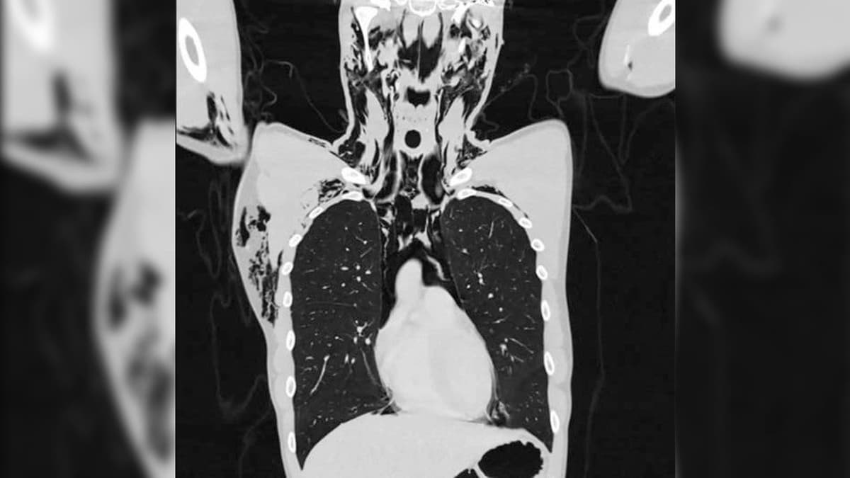 Hombre se masturba tan agresivamente que estuvo en riesgo de morir