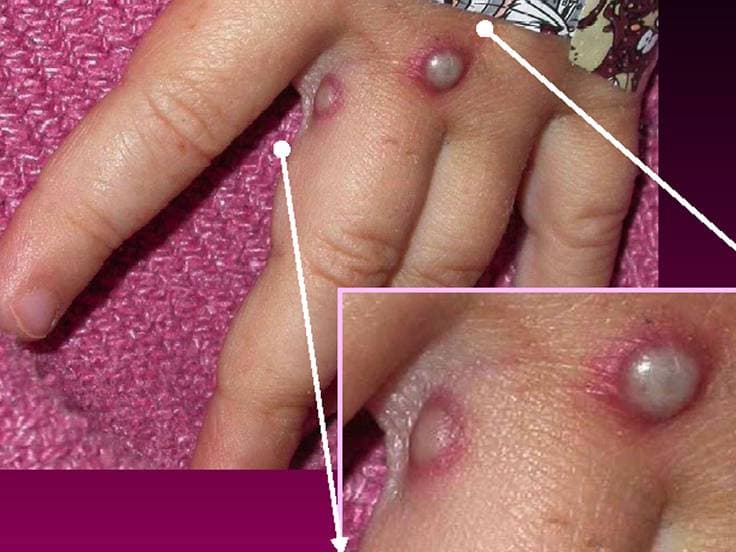 Ahora Israel detecta su primer caso de viruela del mono