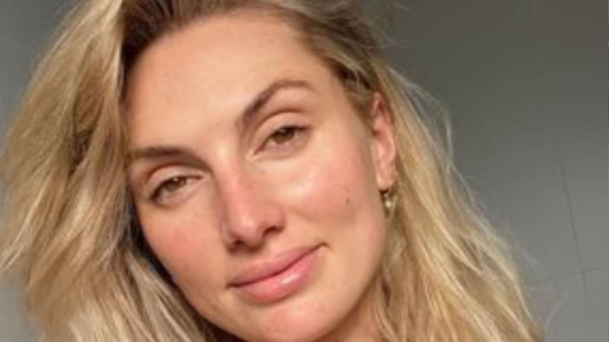 Modelo creyó que le salió una peca en la pierna, se trataba de algo más grave