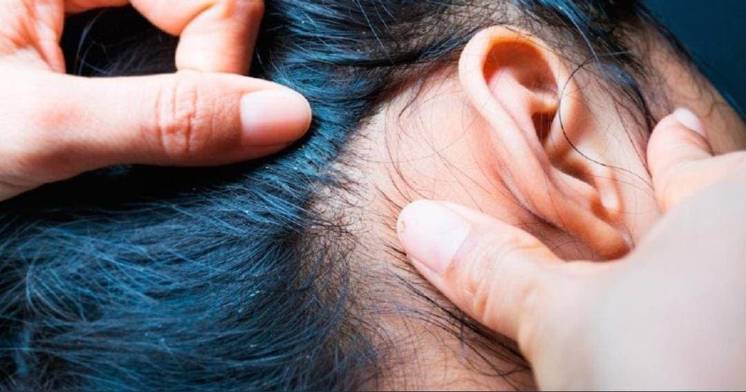 Niña muere por anemia debido a infección de piojos; culpan a la familia