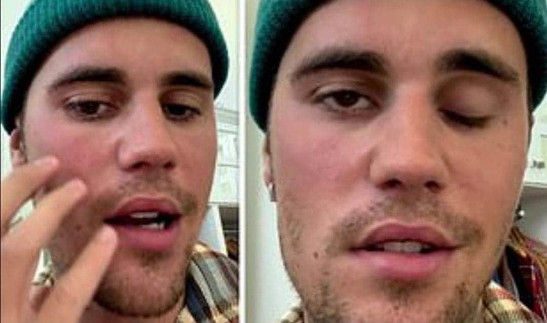 Video: Justin Bieber confiesa que sufre de parálisis facial