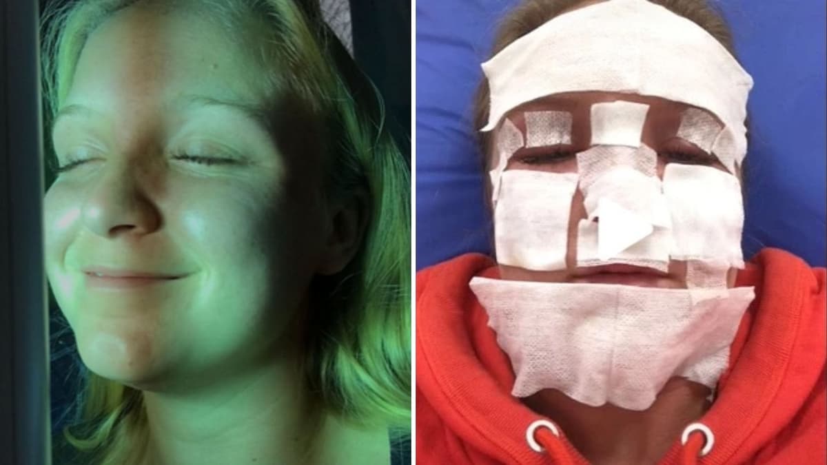 Influencer termina en la clínica con graves quemaduras tras usar una cámara de bronceado