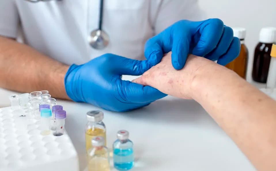 Confirman que hay más de mil 367 casos de viruela del mono en México