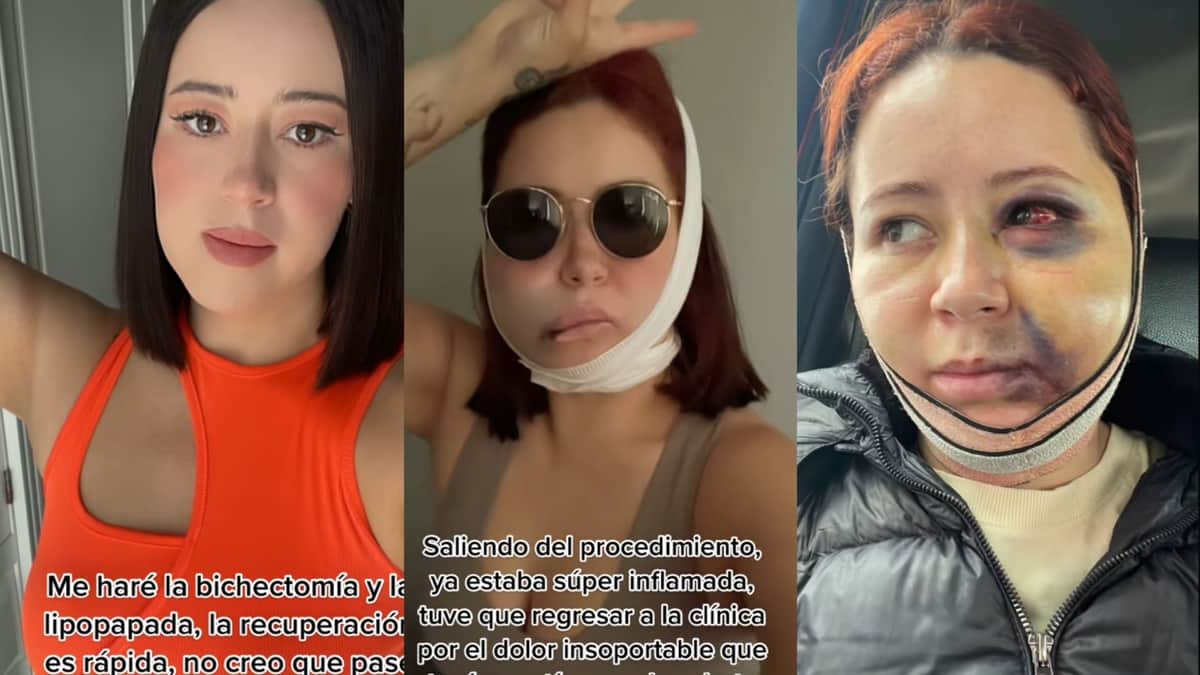 VIDEO: Mujer se hace la bichectomía y resultado sale mal