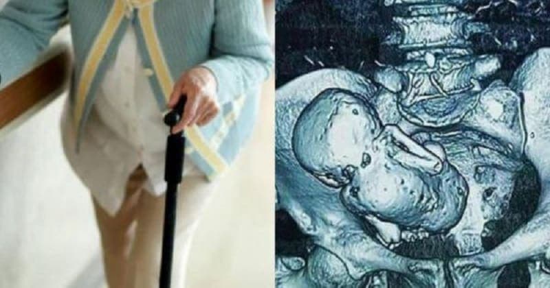 Una mujer brasileña gesta durante más de 50 años a un 'bebé de piedra'