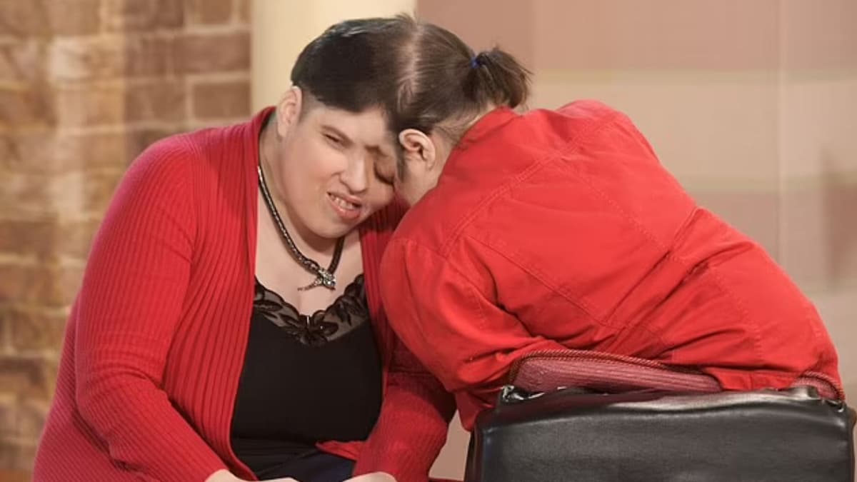 Mueren Lori y George Schappell, gemelas siamesas, a los 62 años