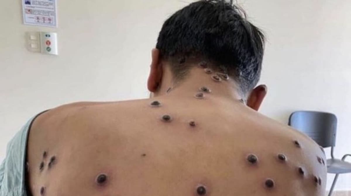 Detectan primer caso de viruela del mono fuera de África, fue en Suecia