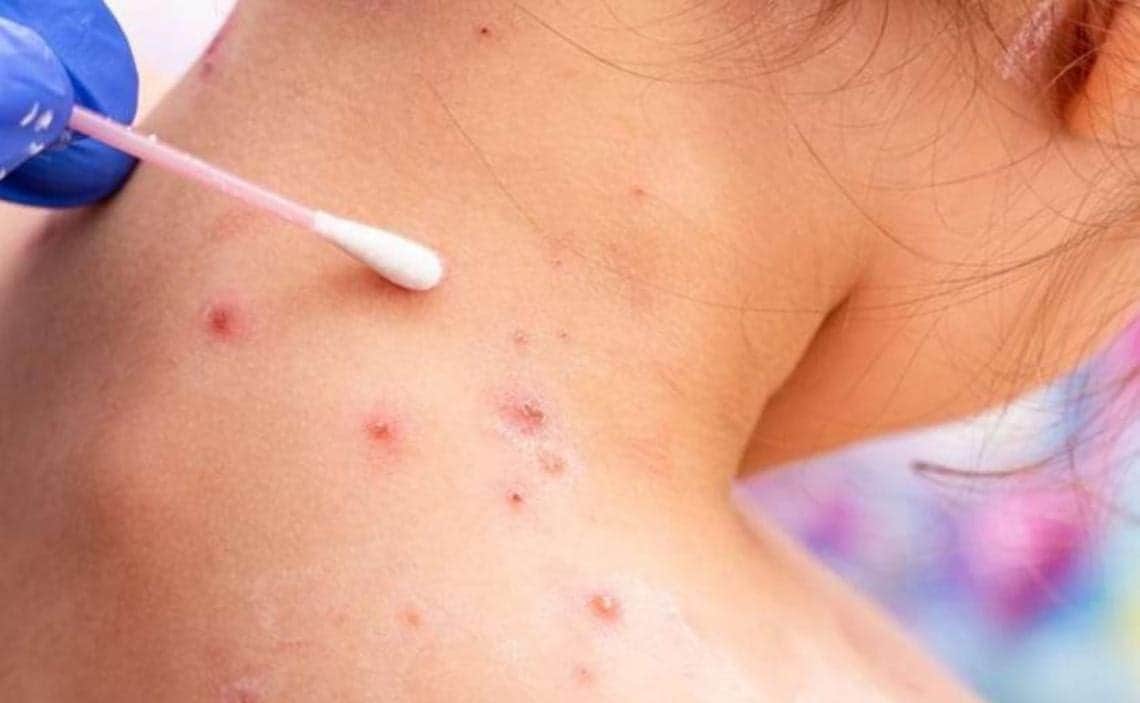 Reportan segundo caso de viruela símica en Playa del Carmen; ciudadano estadounidense sería el contagiado