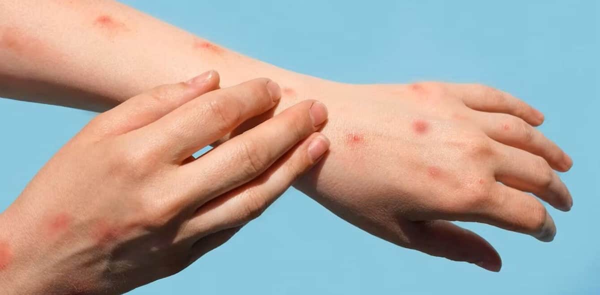 Vacuna de Moderna arroja resultados prometedores contra la viruela del mono