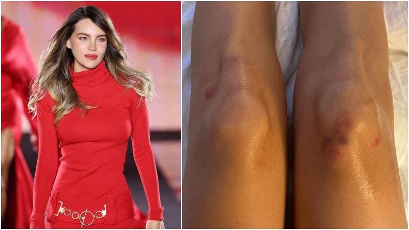 Belinda muestra cómo quedaron sus rodillas tras caída en desfile de modas en París