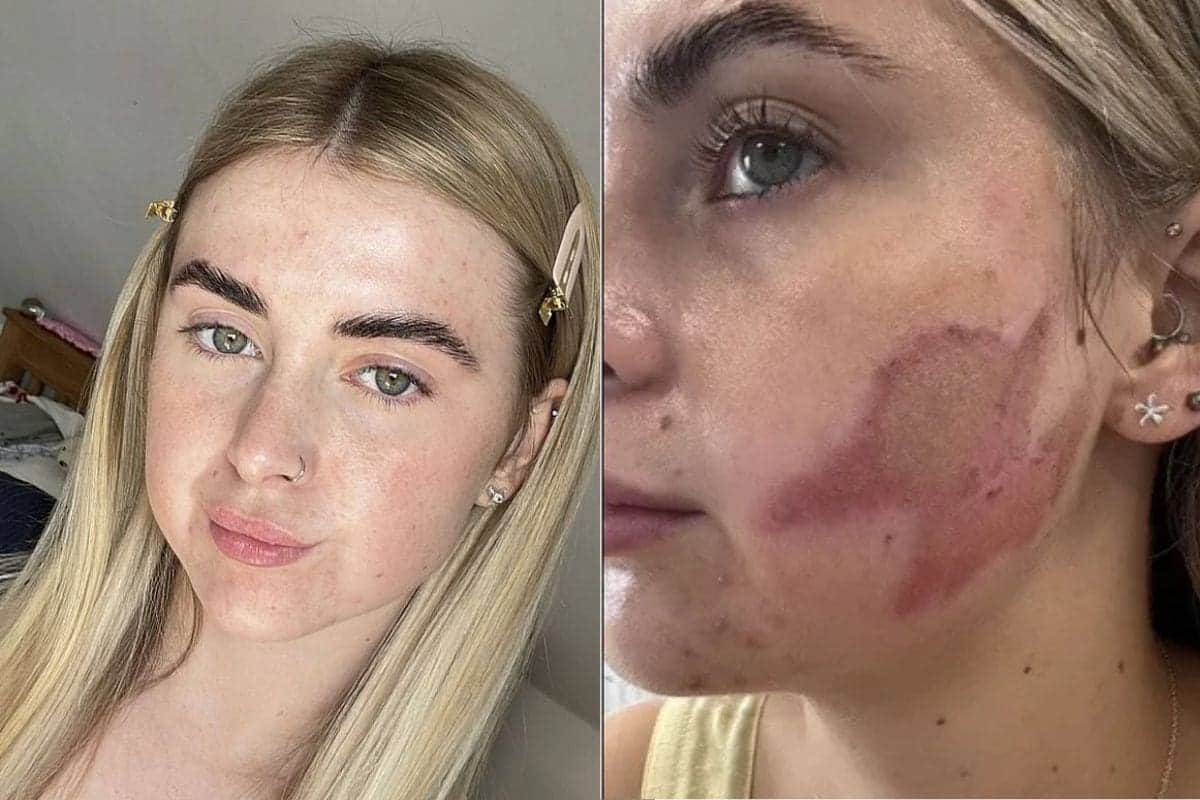 Mujer recibe tratamiento contra el acné y le provocó quemaduras químicas en el rostro