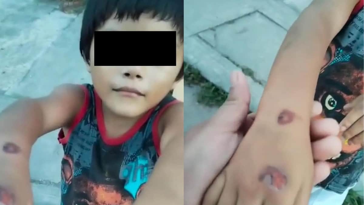 Padrastro quema con encendedor a niño de cinco años en Villas del Sol de Playa del Carmen