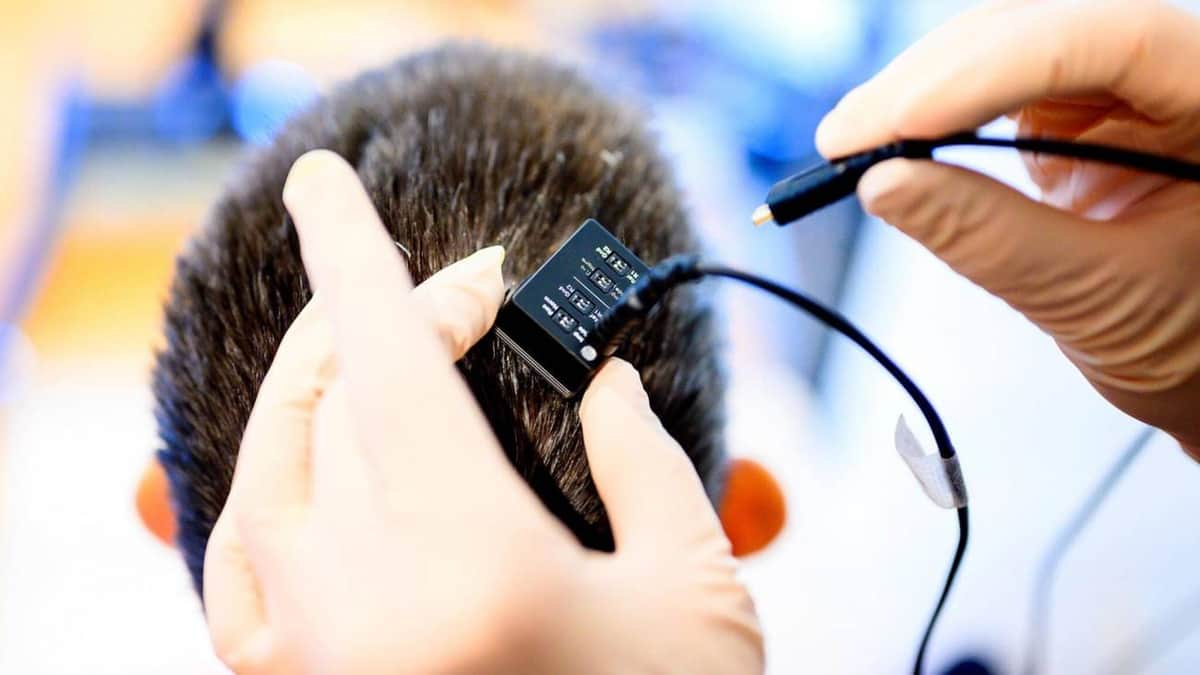Mujer con parálisis logra hablar después de 18 años gracias a un implante cerebral con IA