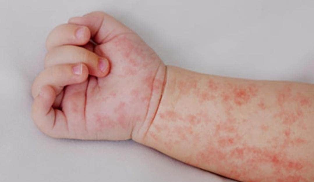 Se confirma primer caso de sarampión en Quintana Roo desde 2019, es una menor de Bacalar