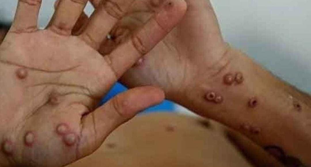 Confirman caso positivo de viruela símica en Quintana Roo; es paciente que fue de Playa del Carmen a Cancún