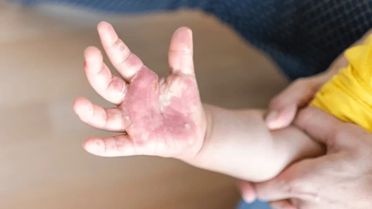 Detienen a hombre por quemarle las manos a sus hijastros menores de edad en Edomex