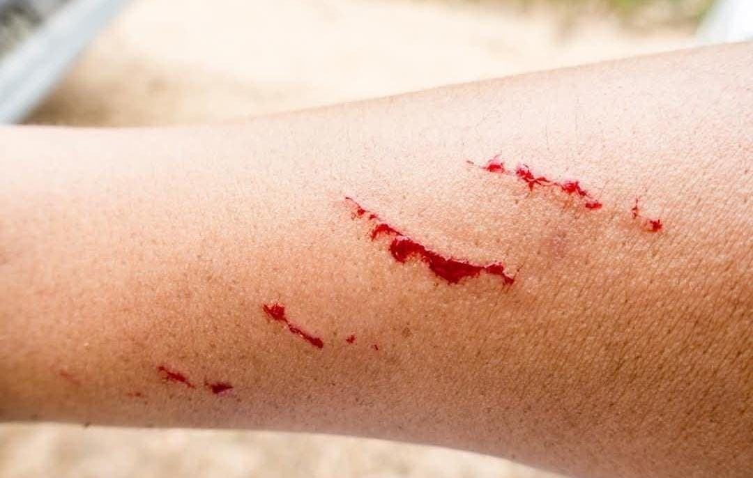 Fallece menor de 17 años por presunto contagio de rabia humana en Zacatecas