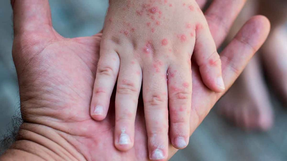 Brote de virus Coxsackie cancela festejos de Día de Muertos en la Sierra de Oaxaca