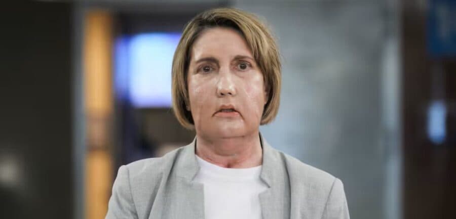 Realizan primer trasplante facial del mundo con una donante que recibió la eutanasia en España