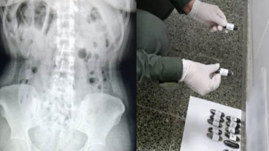 Mujeres quedan al borde de la muerte por trasladar droga en sus estómagos en Argentina