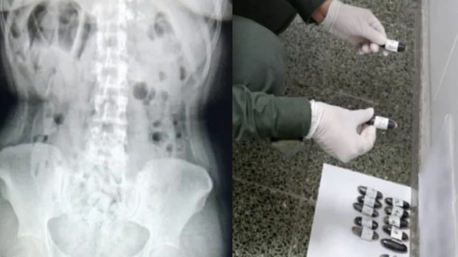 Mujeres quedan al borde de la muerte por trasladar droga en sus estómagos en Argentina