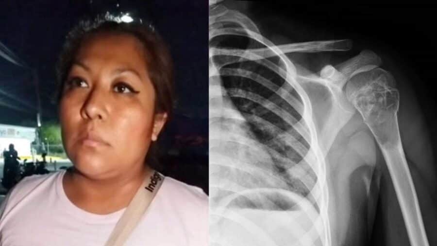 Niño sufre fractura en el hombro tras ser agredido por su compañero con discapacidad en Tehuacán, Puebla